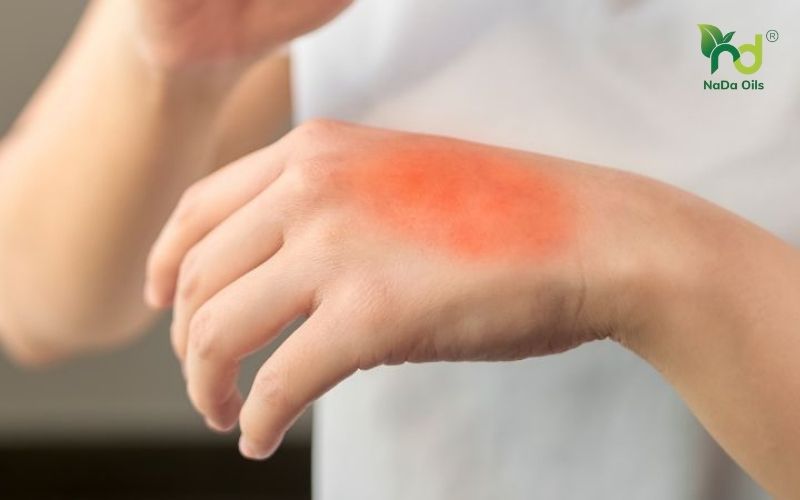 Tinh dầu có gây dị ứng không?